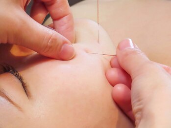 プロぺ鍼灸整骨院/痛みが少ない首肩鍼 [鍼灸/所沢]
