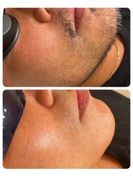 エクシア(excia)/メンズヒゲ脱毛