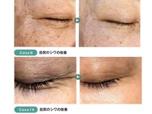 ディオーネ 西船橋駅前店(Dione)/幹細胞導入◇Before After 4