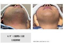 ザ エッセンシャル 碧南(THE Essential)/メンズ　ヒゲ脱毛