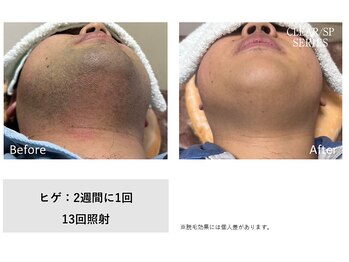 ザ エッセンシャル 碧南(THE Essential)/メンズ ヒゲ脱毛