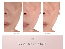 リアン(Lien)/50代 ビフォーアフター