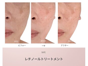 リアン(Lien)/50代 ビフォーアフター