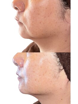 ラ ラナン(La lanun)の写真/筋膜や脂肪層から最新のマシンで小顔デザイン◎