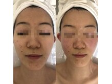 ナラビューティー(NARA BEAUTY)/コルギ1回効果