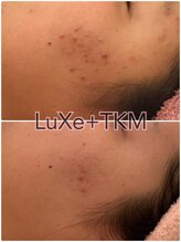 リュクス  Luxe＋tkm 南船場/LDM水玉リフティング