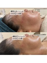 グラン ジュテ/エクソソーム注入×ララピール