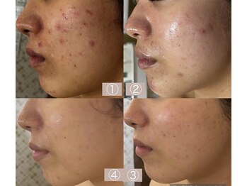 マスカレード 品川(Masquerade)/【症例写真】施術1回