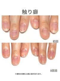 20代/触り癖/3ヶ月後アフター