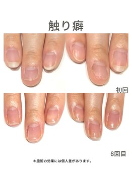 20代/触り癖/3ヶ月後アフター