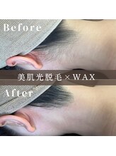 エピナ 千葉店(Epina)/うなじMIX脱毛☆