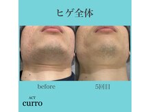 アクト クロ(ACT curro)/【ヒゲ全体】脱毛施術例