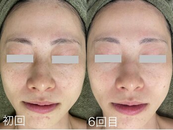 サロンドジェシカ(salon de Jessica)/毛穴洗浄+美肌フォト