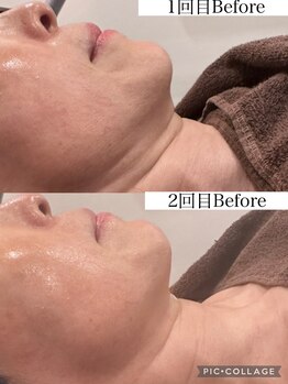 ウォーム(Warm)/50代　フラクショナル施術例