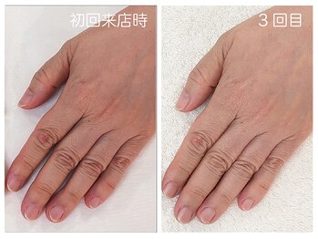 キレイテ 福岡天神店/手荒れと乾燥