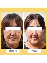 クローバー(clover)/【before/after】施術１回目翌日