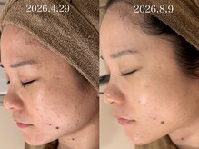 ミュー 岡崎店(mieux)の雰囲気（★ニキビ・毛穴対策！定期的なメンテナンスとスキンケアで改善♪）