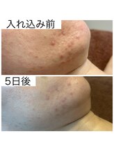 グラナーダ(granada)/ハーブLV3ビフォーアフター