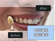 ホワイトニングカフェ 綾瀬店(WhiteningCafe)/◎歯のホワイトニング施術写真◎