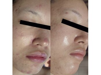 ホワイトアクア 梅田本店(WHITE AQUA)/ララピール/大阪/梅田/毛穴/小顔