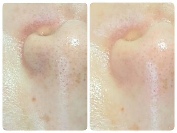 トータルビューティ ノイド(Noid)/毛穴洗浄 お試し全顔