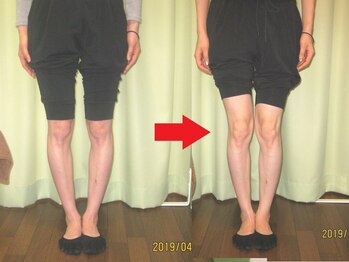 チャラク(charaku)/【30代S様：O脚矯正・骨盤矯正】