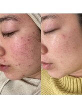 ラルーナ(La Luna)/ハーブピーリング★