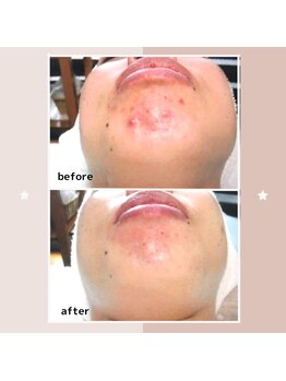 レゾン 京橋店/【ビフォーアフター】ニキビケア