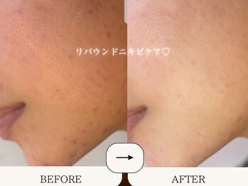 ハイフン(HIFUN)/クリスティーナ脂性/ニキビケア