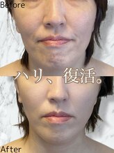 ルミライ(Lumirai)/たるみ改善|毛穴|フェイシャル