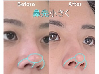 ラプリアンジュ 鹿児島天文館店(Raplit ange)/隆鼻+輪郭矯正40分10回