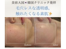 ユフラ(Juhla)/特許成分配合ララピール