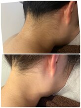 リンク(LINK.)/うなじ光脱毛