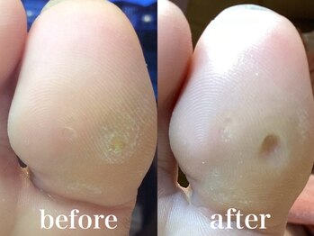 ドクターネイル爪革命 札幌本店/症例紹介17 たこ・うおのめ