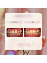 プラスビー 2号店(+b)/ホワイトニングビフォーアフター
