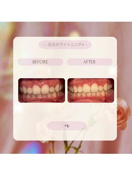 プラスビー 2号店(+b)/ホワイトニングビフォーアフター