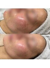 サロンドブランシール(salon de blanchir)/シミケアビフォーアフター