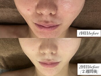 サロンワイアネシス(Salon y ANESIS)/ハーブピーリング 