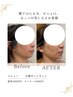 《北見初》【即変化】お顔キュン引上げコース　モニター　49800円→14980円