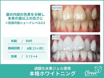 クレア(Crea)/【ホワイトニング症例写真】