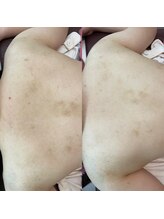 ベル(Bell)/ブライダル背中トリートメント