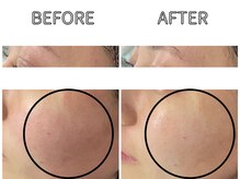 ライム 池袋東口(LIME)/ ハーブピーリング｜赤みケア