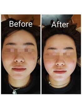 美藤鍼灸院/美容鍼のBefore After