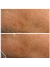 エピシア(EPICIA)/ララピールはシミ緩和も得意★