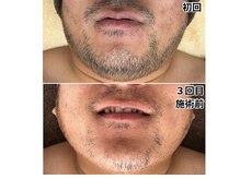 オルビ(OLBI)の雰囲気（【メンズ歓迎】ヒゲ&VIO脱毛を強化したルミクスA9X最新機種♪）
