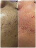 モニター募集10名【何をしても改善されないニキビに終止符】光フェイシャル