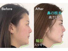 ラプリアンジュ 鹿児島天文館店(Raplit ange)/隆鼻＋輪郭矯正40分10回