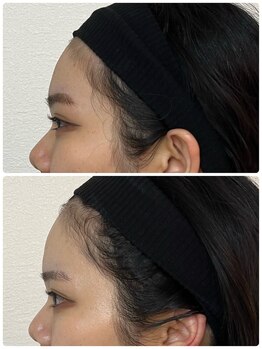 ルミア(LUMIA)/20代／顔の立体感がもっと欲しい