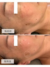 ラシック(La Chic)/シミケア8回