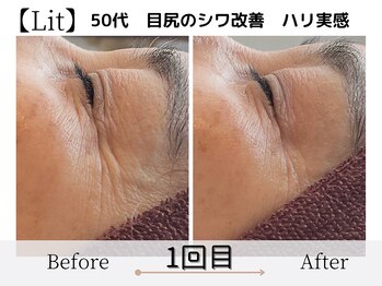エミフル(emifull)/自分の肌に落ち込んでたけど、、